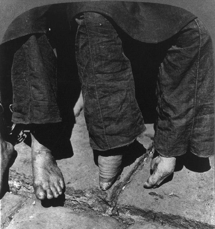 图一，1902年未缠足妇女（左）与缠足妇女的比较